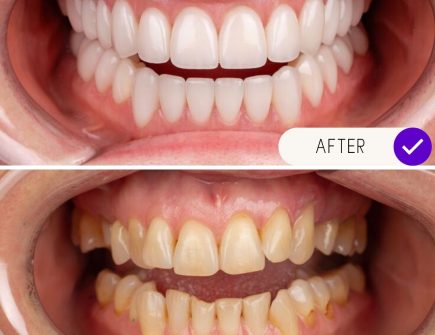 Patient smile restoration with full dental implants before and after