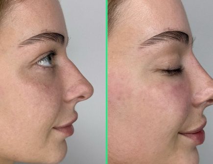 Before and after closed rhinoplasty at Vivid Clinic showing refined nasal tip and smooth bridge.