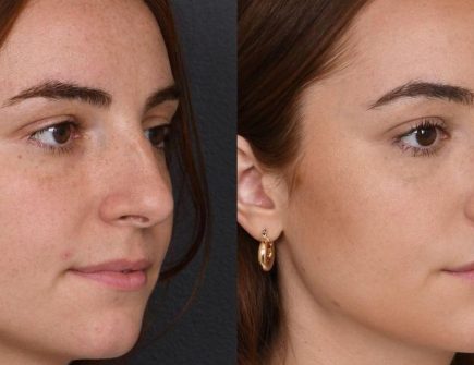 Best rhinoplasty surgeons in Istanbul offering high-quality, natural-looking nose reshaping procedures with affordable prices and top-tier results at Vivid Clinic.