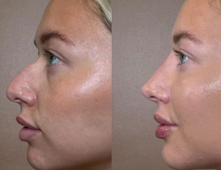 Before and after rhinoplasty results showing a reshaped nose.