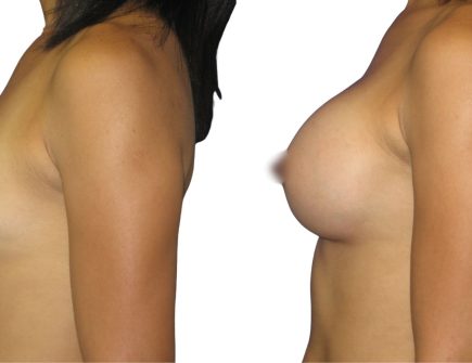 Breast Augmentation Before and After Recovery in Istanbul