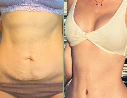 Tummy Tuck Surgery in Istanbul - Vivid Clinic Post-surgery results of a toned abdomen and contoured waist after high-definition liposuction and tummy tuck at Vivid Clinic