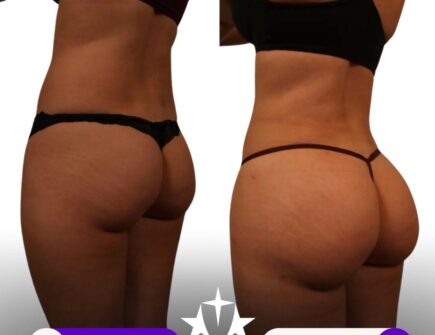 Before and after BBL surgery at Vivid Clinic showing a natural, fuller shape.