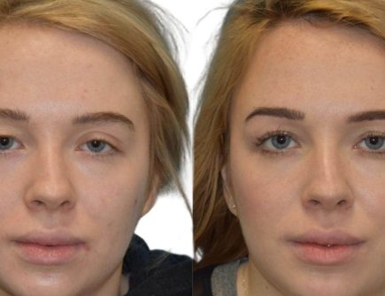 Blepharoplasty results showing improved eye shape and contour.