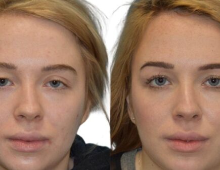 Blepharoplasty Before and After : See the remarkable results of upper blepharoplasty in these before and after photos. Book your consultation now and discover how we can rejuvenate your upper eyelids.Blepharoplasty results showing improved eye shape and contour.