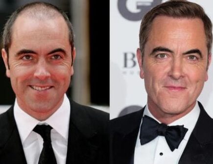 Celebrity Hair Transplants: Before and After at Vivid Clinic