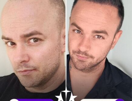 Recovery Stages of FUE Hair Transplant | Hair Transplant Journey at Vivid Clinic Istanbul, Turkey