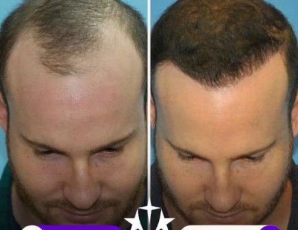 Hair Transplant Journey at Vivid Clinic Istanbul, Turkey