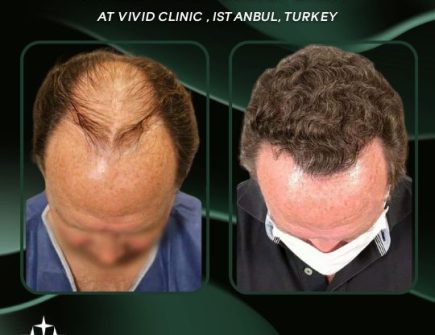 Hair Transplant Journey at Vivid Clinic Istanbul, Turkey